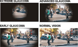 GlaucomaTunnelvision4