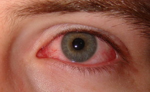 Dry Eye Syndrome